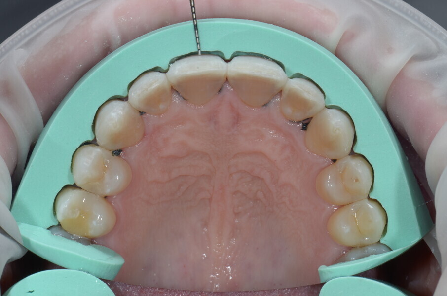 Fig. 9: Sectioned silicone index to check the calibrated spaces from the middle thirds to the cervical thirds of the teeth.