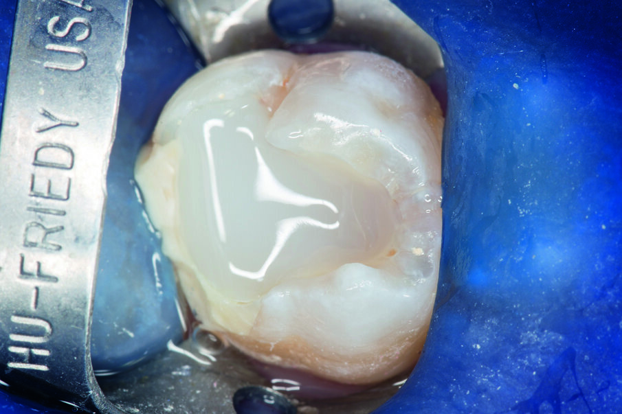 Fig. 5: SDR® Plus first increment was light-cured for 20 sec, before a second layer of SDR® Plus was placed and light-cured. 