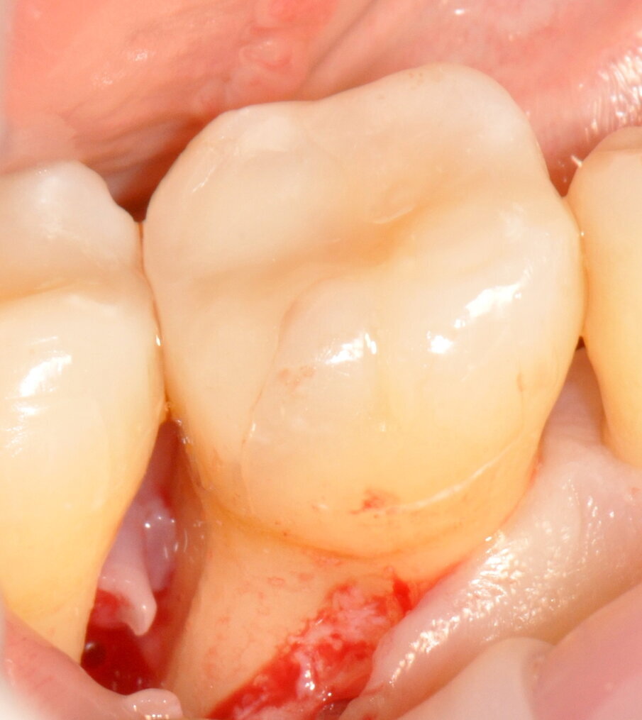 Fig. 9 - Difetto esposto completamente.