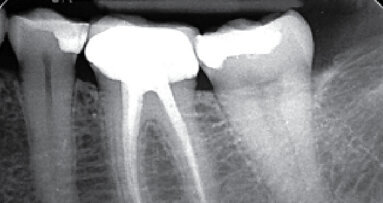Prípad diagnostikovania až po sprístupnenie