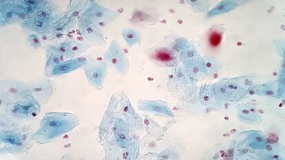 Изследователи от Обединеното кралство идентифицират бактерии, способни да унищожават рака на главата и шията