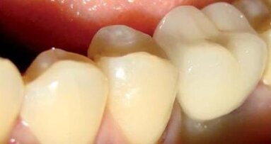 Rekonstrukcja implantoprotetyczna pierwszych trzonowców w żuchwie z wykorzystaniem systemu BEGO Semados®