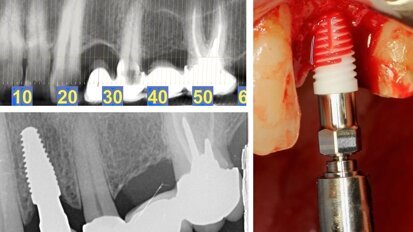 Rehabilitación estética en la región posterior con implantes cerámicos