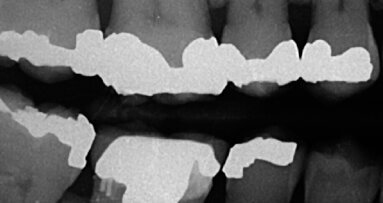 Gestione dei molari superiori