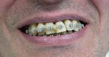 Ogni promessa è debito… (anche in odontoiatria)