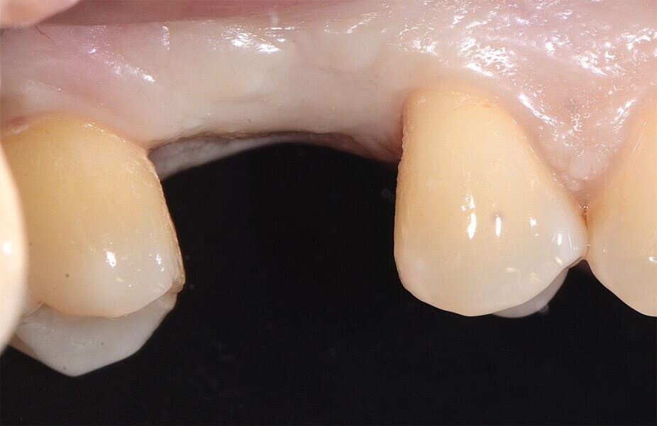 Fig. 4 : Cicatrisation de l’alvéole préservée.