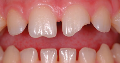 Case report. Restauro diretto multi shade con Filtek™ Supreme XTE