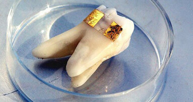 Nanosensor auf Zahnschmelz spürt Bakterien auf