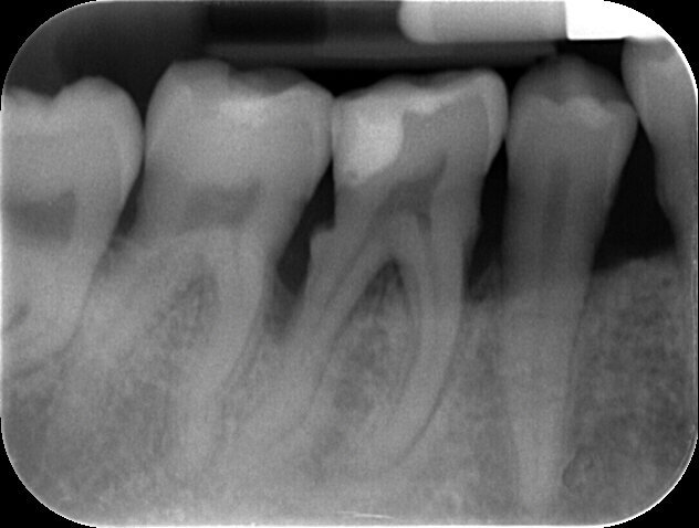 Fig. 5 - Rx peri-apicale dell’elemento 4.6: difetto intra-osseo e abbondante presenza di tartaro.