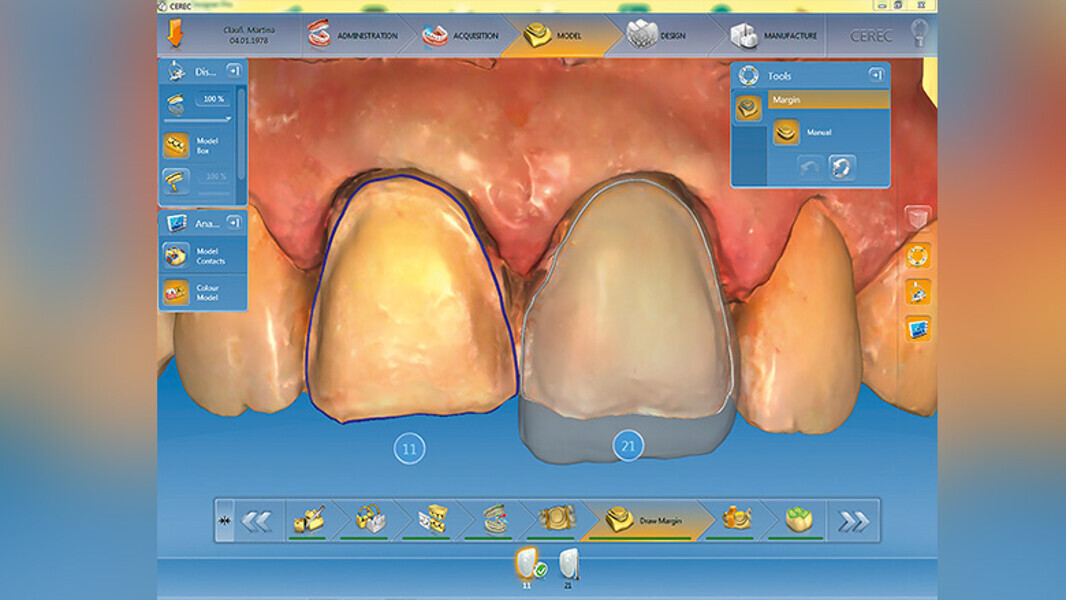 Fig. 7. Diseño de las carillas de cerámica híbrida con el software CEREC.