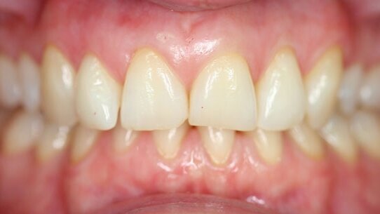 Kosmetische Zahnregulierung