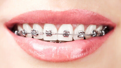 Mundhygiene-Experten forschen an neuer Bracket-Reinigung