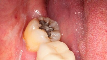 שילובים גנטיים מסוימים עשויים להיות אחראיים על רגישות לכספית