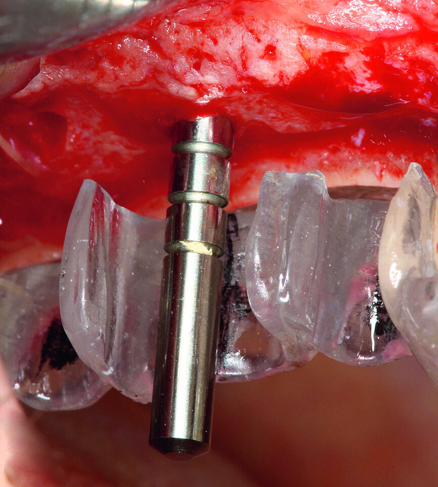 Fig. 7 : Guide de parallélisme.