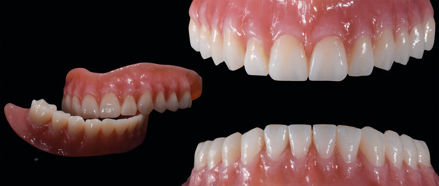 Fig. 21: Individualised, digitally produced complete maxillary and mandibular dentures in their finished state (CediTEC).