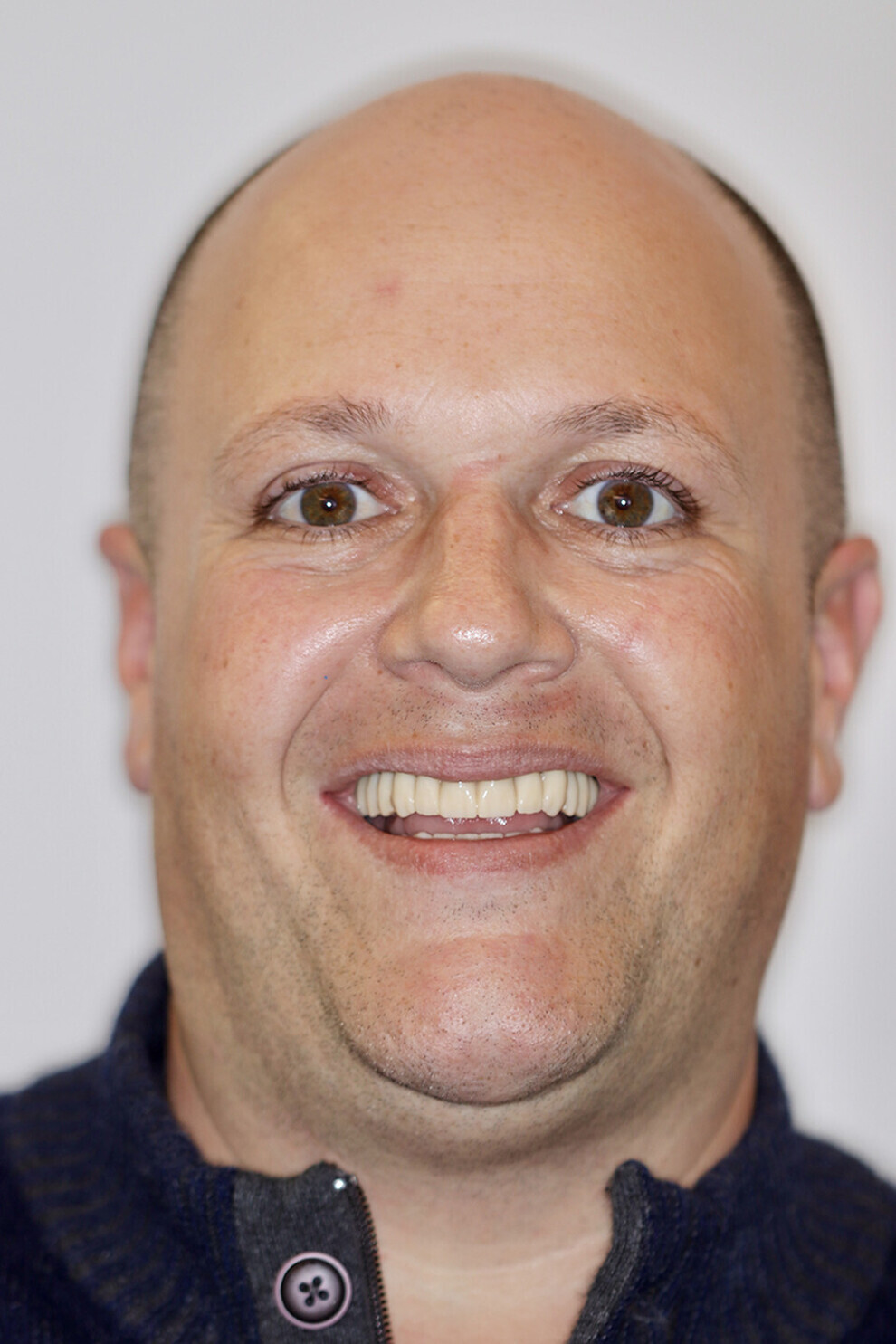 Fig. 17c: Final patient smile showing excellent aesthetics and a happy patient.