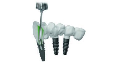 Les sociétés Heraeus Kulzer, Straumann et Createch trouvent un accord et mettent fin à la procédure judiciaire