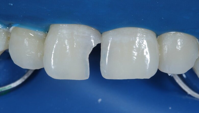 Fig 7: Excavation completed