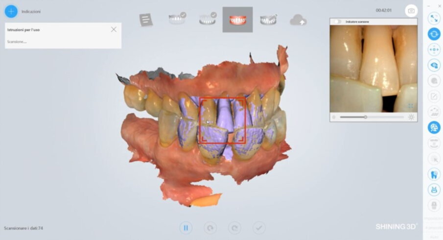 Figg. 11-12_Matching dell’arcata superiore e inferiore.