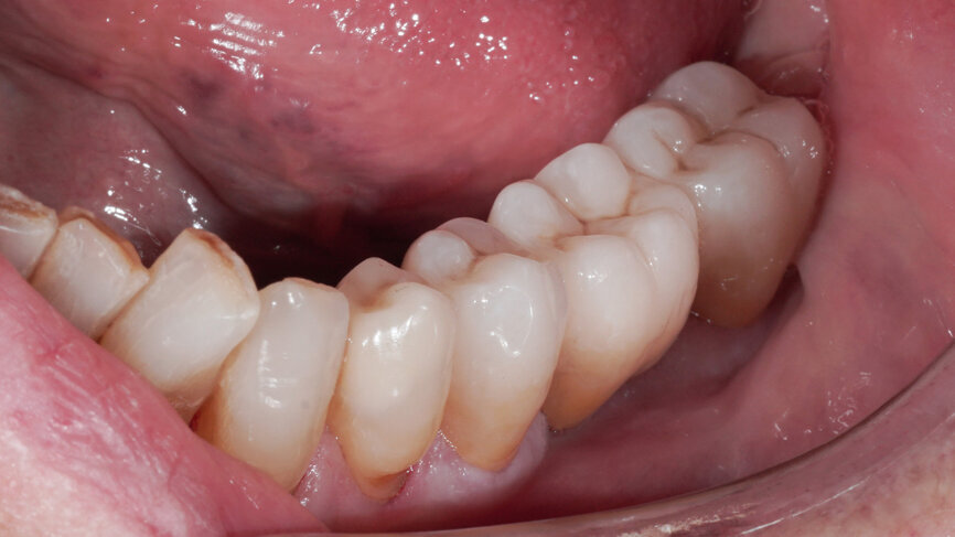 Fig. 12: Clinical situation after restoring the teeth with a lithium disilicate onlay and a zirconia bridge.