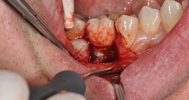 Rola higienistki w długofalowym prowadzeniu pacjenta implantologicznego