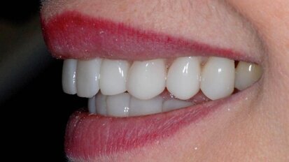 Licówki porcelanowe GlamSmile nakładane na zęby dolne i górne. Analiza kliniczna – Część 1