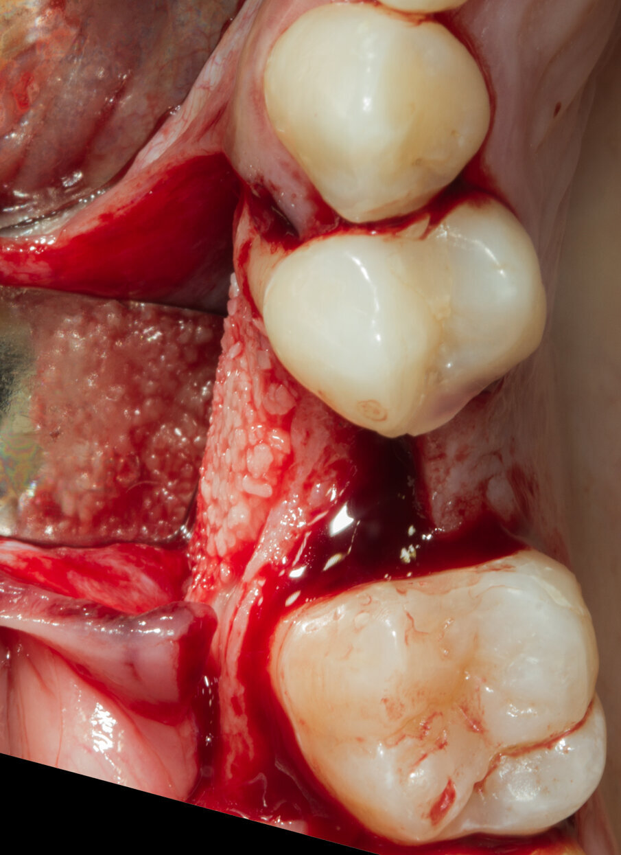 Fig. 9 - Il biomateriale è stabile, senza dislocazione dei granuli.