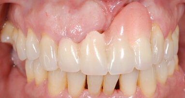 Gestione dei tessuti molli in un caso di malposizionamento implantare in area estetica