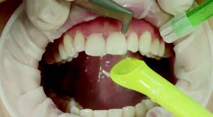 Fig. 4: Removal of supragingival biofilm and stains, also in contact with the gingiva