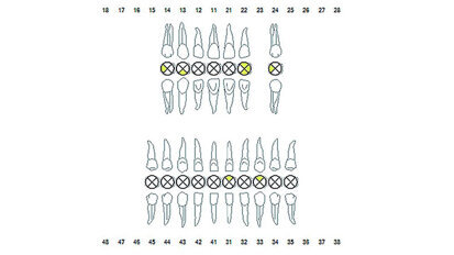 Οξεία περιοδοντίτιδα και αρνητική κλινική πορεία σε ασθενείς με κίρρωση του ήπατος.