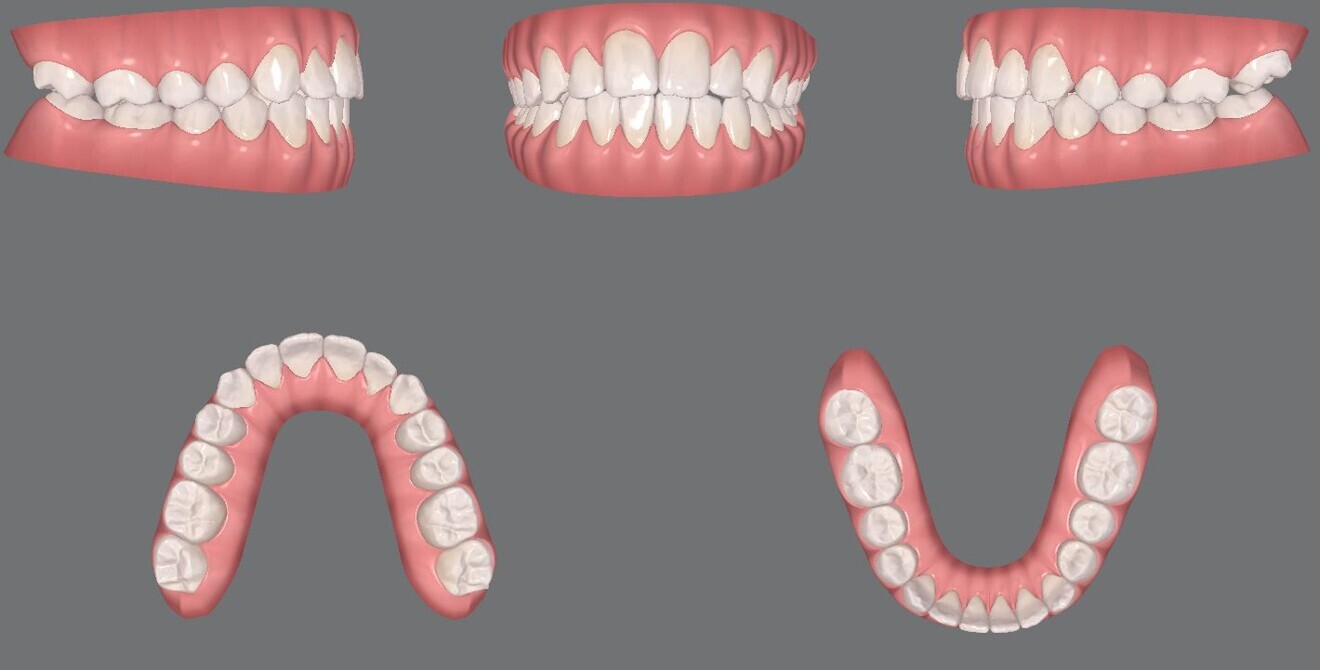 Figs. 12a–e: Pre-aligner treatment digital models
