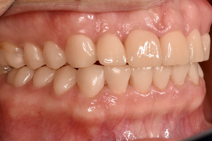 Fig. 11c: Temporarily cemented long-term provisional restorations. Right lateral view. 