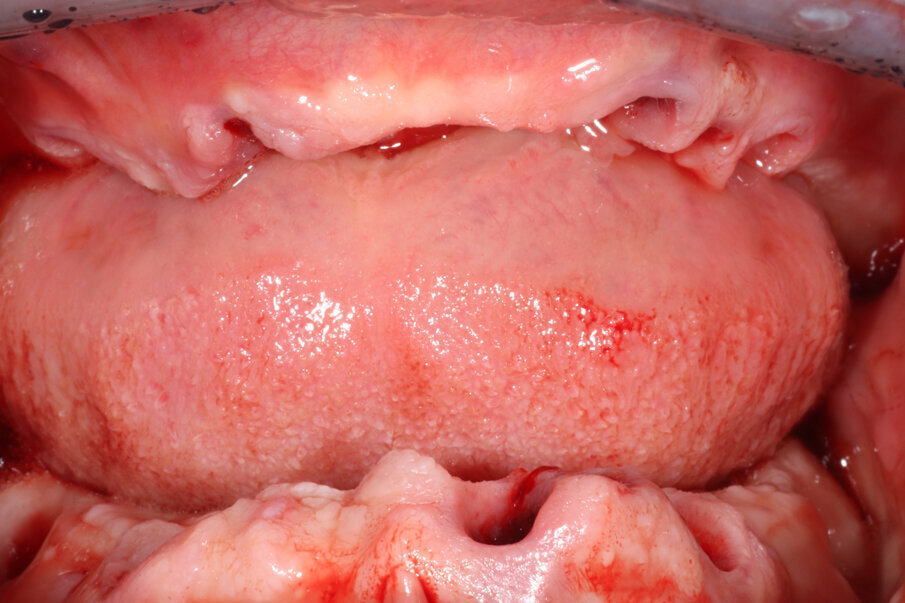 Fig. 3_Estrazione di tutti gli elementi dentali e degli impianti compromessi.
