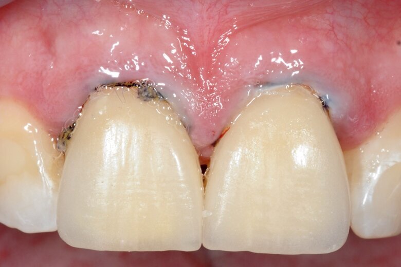 Fig. 24 Immediately post-op.