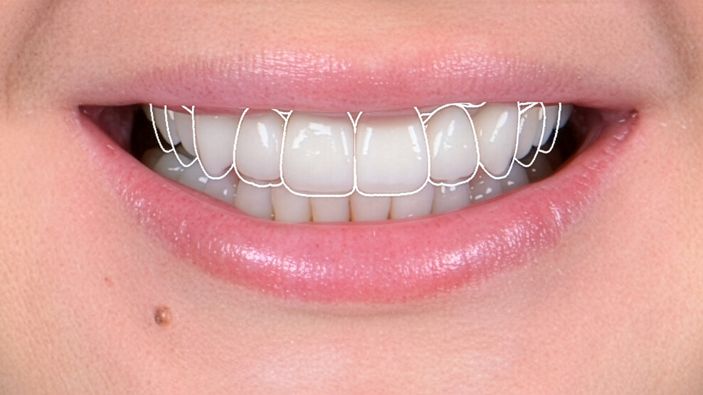 Fig. 2: Digital smile design based on a facial photograph.