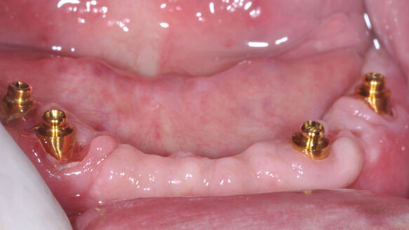 Upper and lower dentures on Rhein83 components