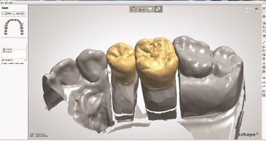 Timski igrači: efikasnost i estetika  -  Nadoknade pune morfologije napravljene od translucentnog cirkonijum-dioksida