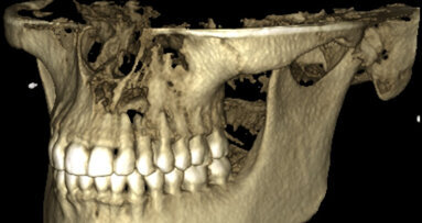 New perspectives in periapical surgery: Flap detachment and retraction