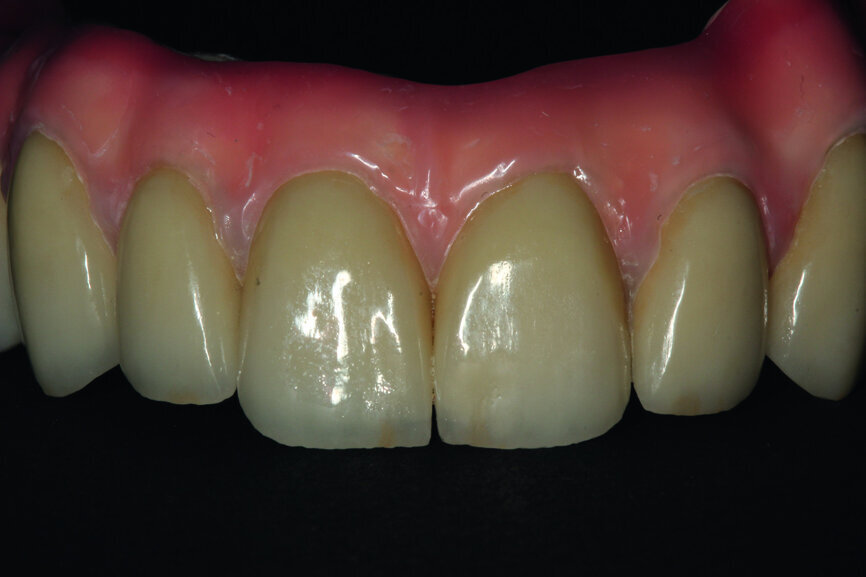 Fig. 25: Magnification showing precision in the making of the crowns and in veneering by means of pink composite.