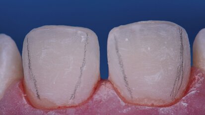 Estetska kamuflaža i korekcija hipomineralizacije sekutića uzrokovane traumom