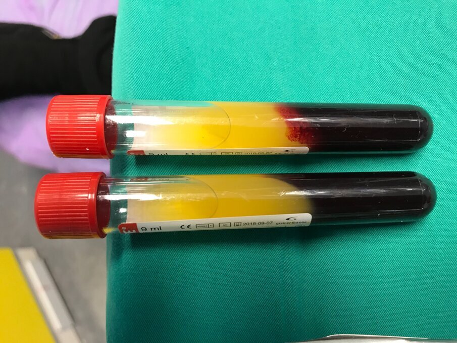 Fig. 8 - Campione autologo di sangue subito dopo la centrifugazione.