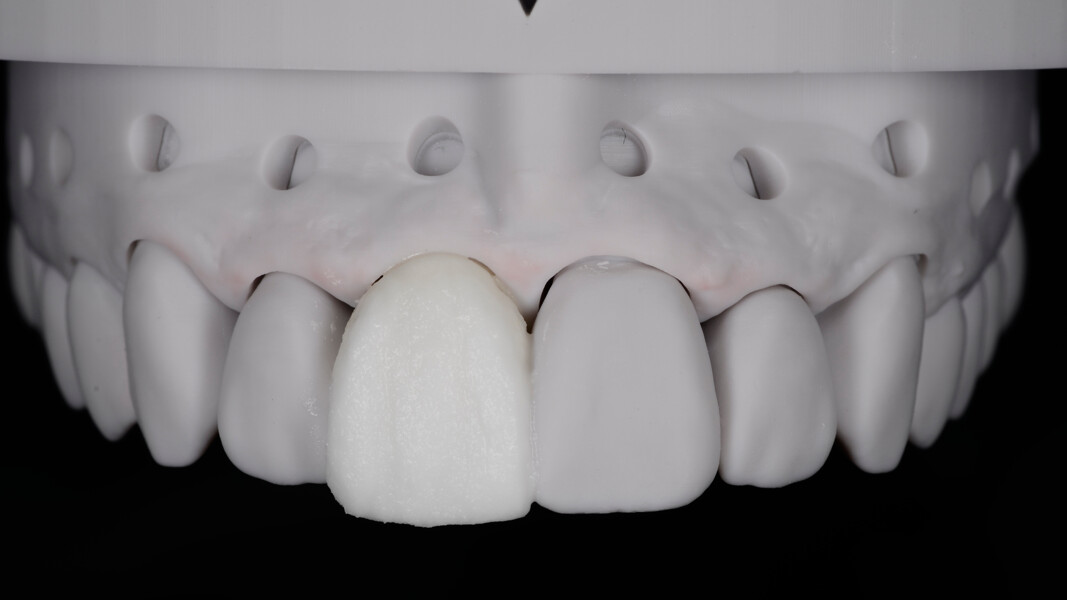 Fig. 22: Use of CERABIEN ZR Luster in Shade ELT1 for the main body, Shade LTX for the incisal area and Shade ELT3 for the ridges.