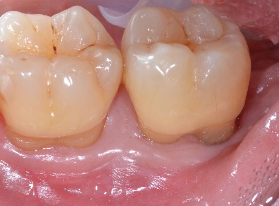 ig. 13 - Aspetto dei tessuti parodontali a guarigione avvenuta (follow-up a 24 mesi).