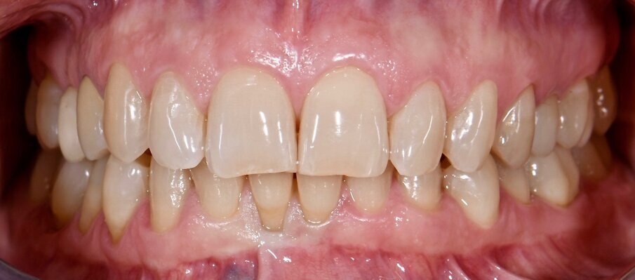 Fig. 5a - Condizione clinica ad 1 anno: visione frontale.