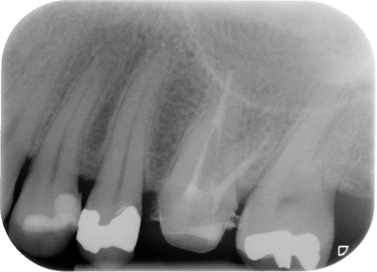 Fig. 10 : Radiographie initiale de la dent 26 nécessitant un retraitement ; un tenon fibré est visible dans le canal palatin.