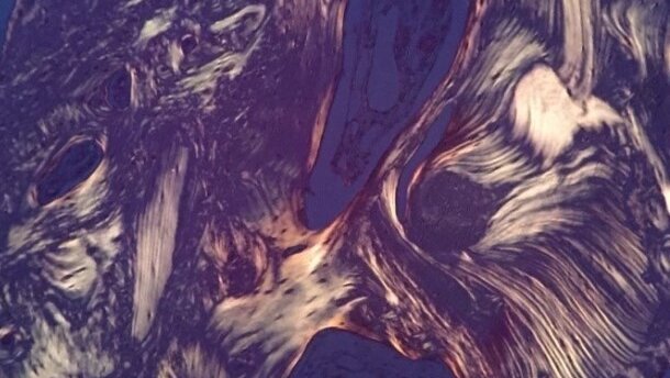 Jednoetapowe hydrokinetyczne podniesienie dna zatoki szczękowej z wykorzystaniem kwasu hialuronowego