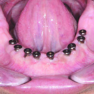 Fig-18-Crête-mandibulaire-quatre-mois-après-l’intervention-300x300-