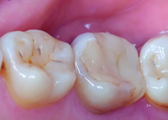 Fig. 14a: Clinical image: Pre-op.