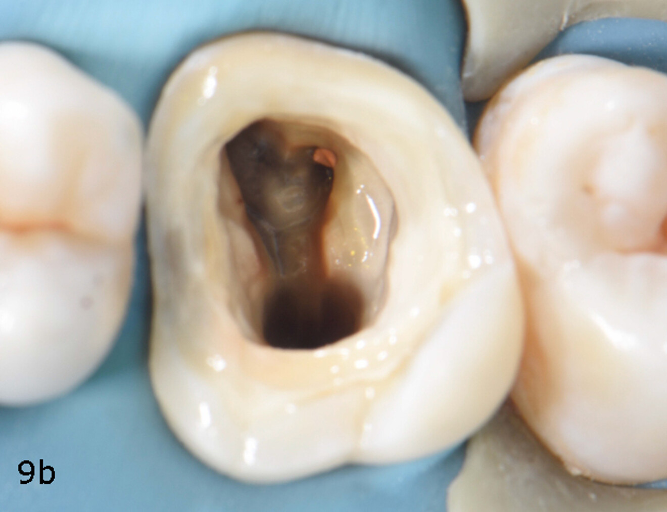 Fig. 9a & b: Immediate dentine sealing before endodontic treatment using CLEARFIL SE Protect Primer (a), followed by CLEARFIL SE Protect Bond (b).