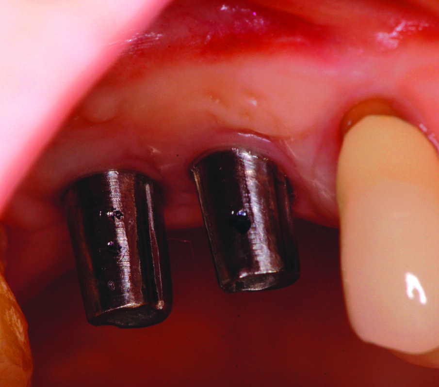 Figg. 13-15_Particolari dei monconi in titanio e delle corone in metallo ceramica.